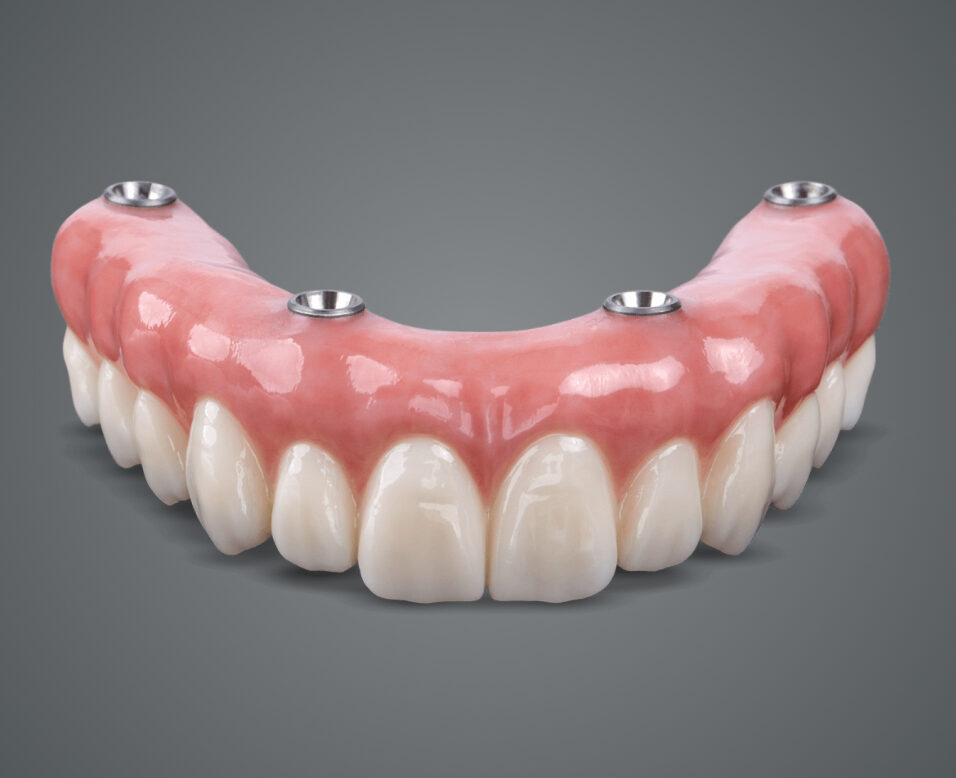 Fixed Upper Denture